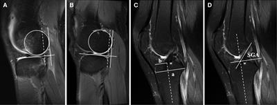 Preoperative excessive lateral anterior tibial subluxation is related to posterior tibial tunnel insertion with worse sagittal alignment after anterior cruciate ligament reconstructions